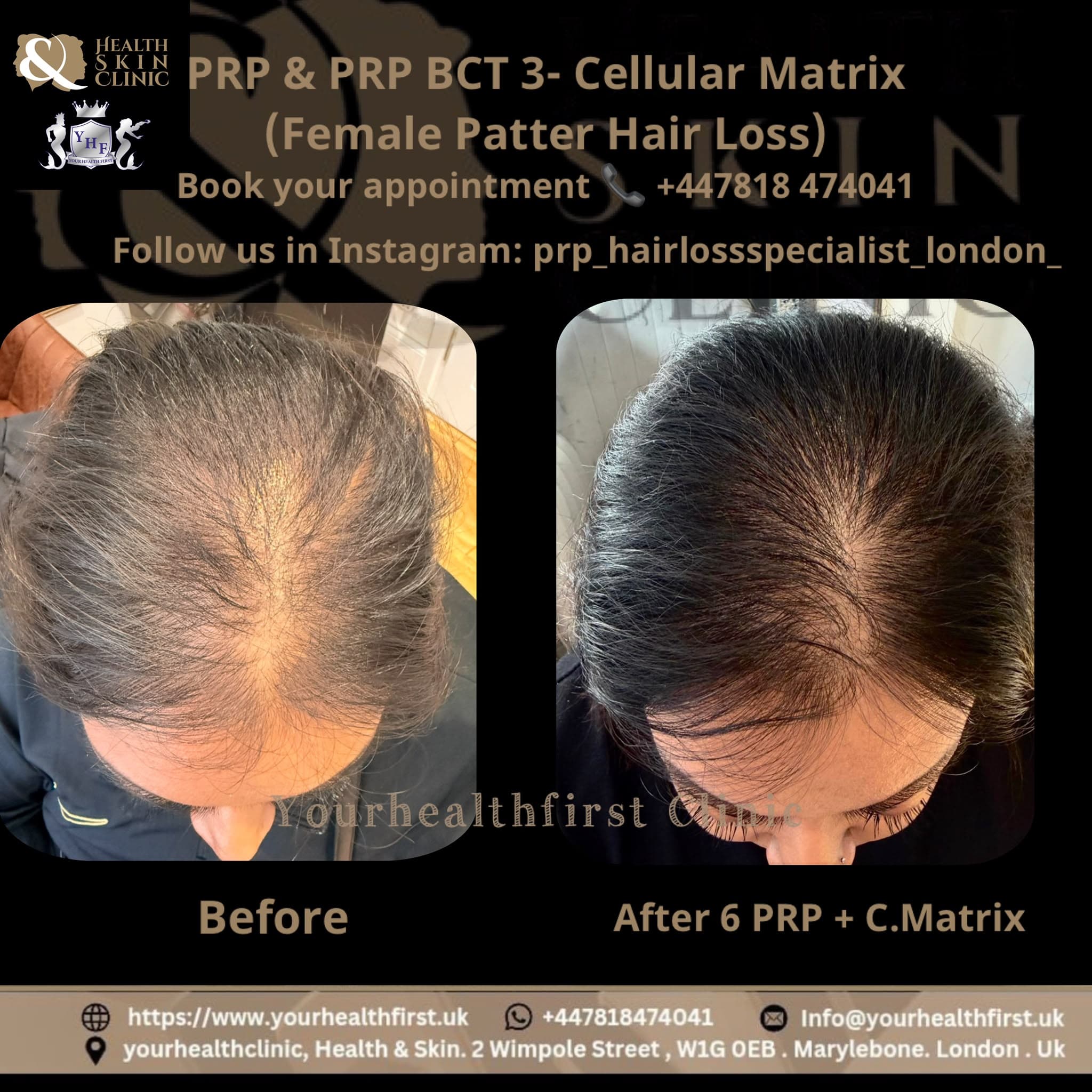 PRP Hair Loss Treatment before & after — result 2