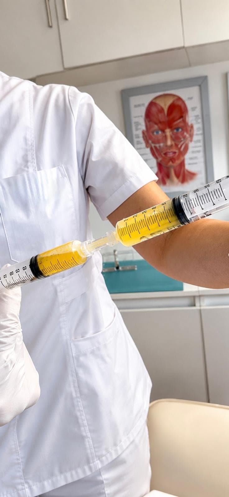Prepared PRP syringes ready for treatment