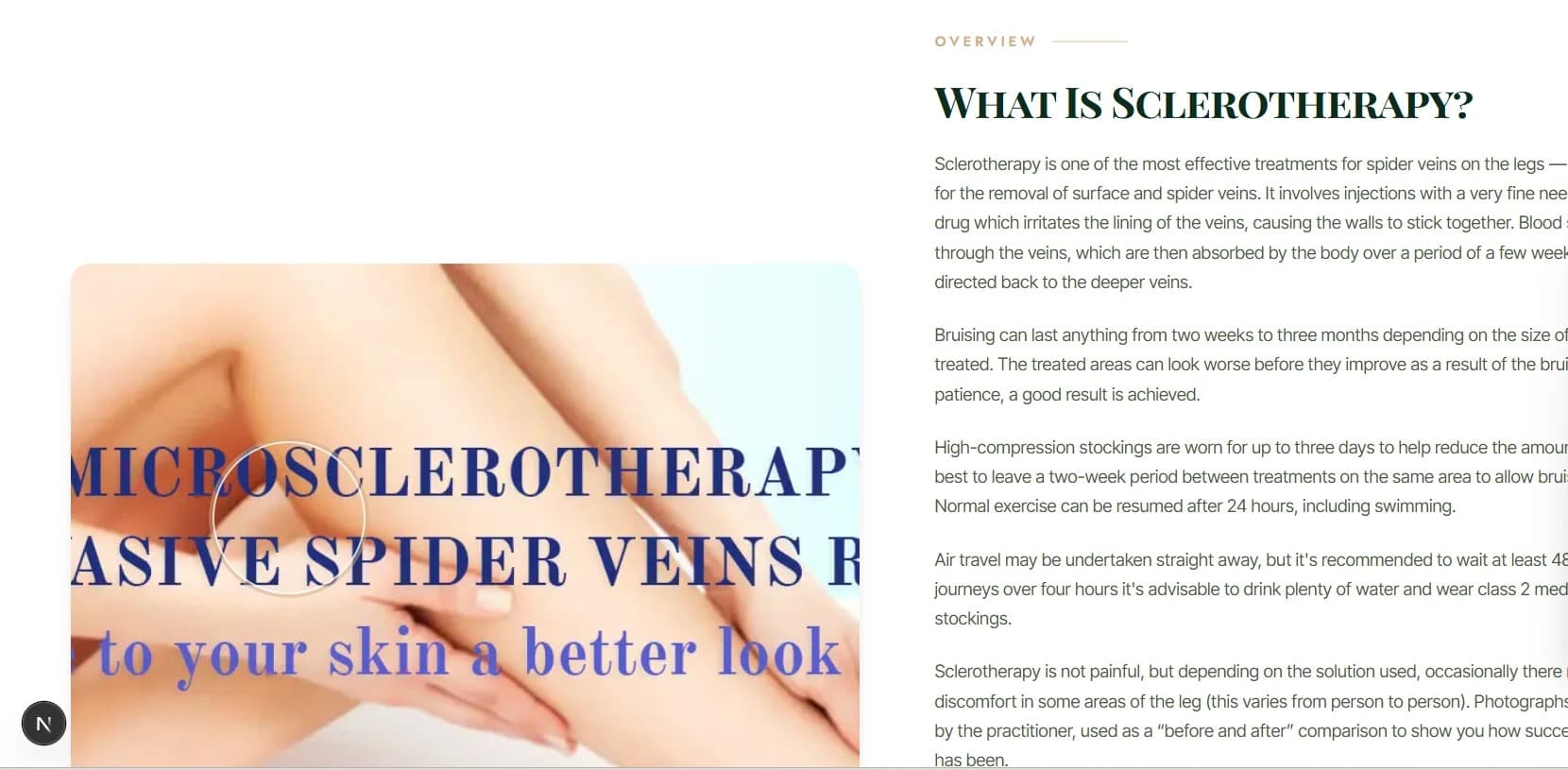 Microsclerotherapy — a treatment option for selected thread veins